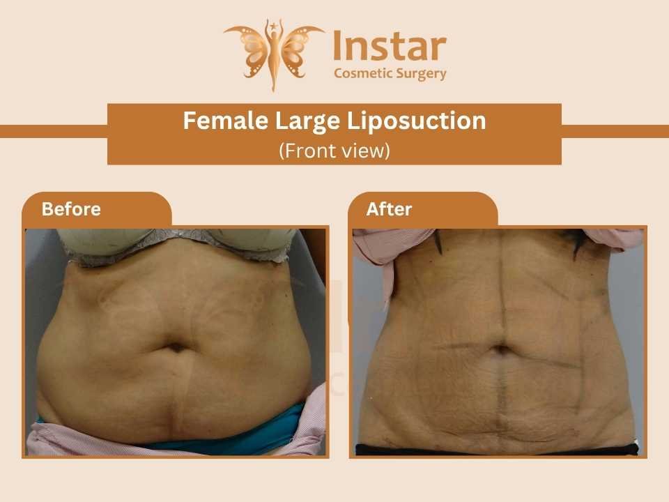 Female-Large-liposuction-2 front view-2